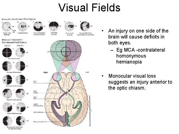 Visual Fields • An injury on one side of the brain will cause deficits