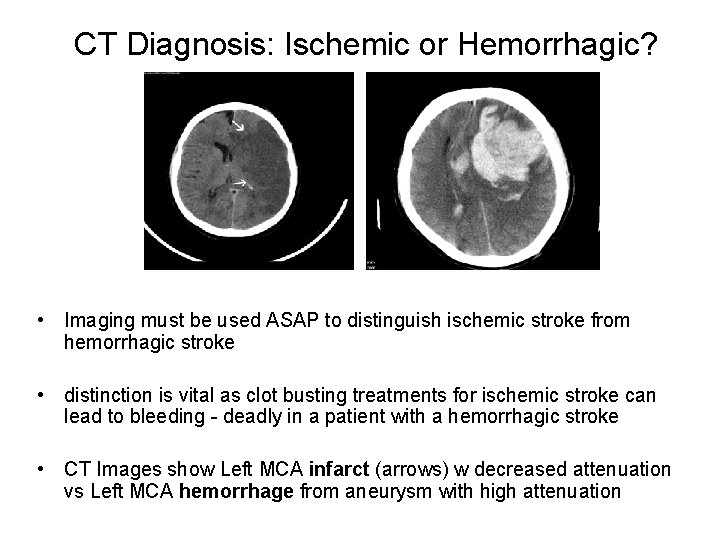 CT Diagnosis: Ischemic or Hemorrhagic? • Imaging must be used ASAP to distinguish ischemic