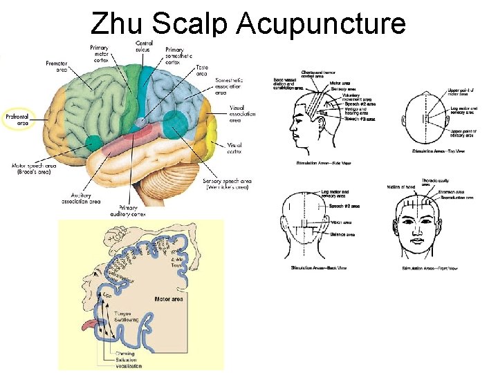 Zhu Scalp Acupuncture 