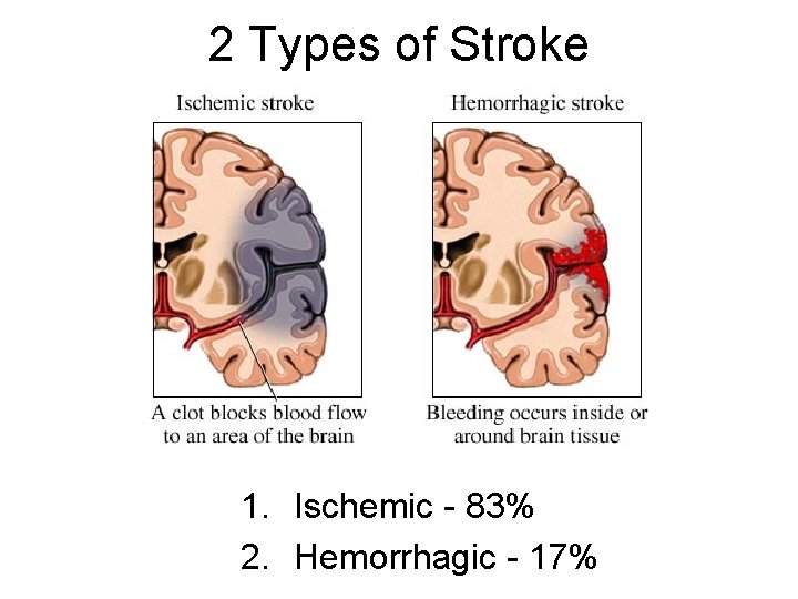 2 Types of Stroke 1. Ischemic - 83% 2. Hemorrhagic - 17% 