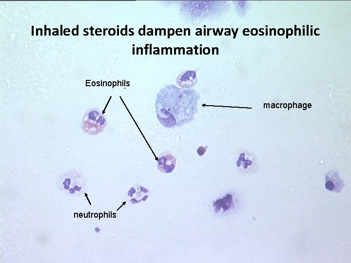 Inhaled steroids dampen airway eosinophilic inflammation Eosinophils macrophage neutrophils 