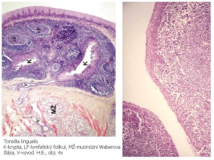 Tonsilla lingualis K-krypta, LF-lymfatický folikul, MŽ-mucinózní Weberova žláza, V-vývod. H. E. , obj. 4