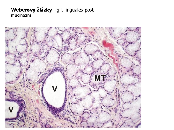 Weberovy žlázky - gll. linguales post mucinózní Weberova mucinózní žláza MT-mucinózní tubuly, V-vývod. H.