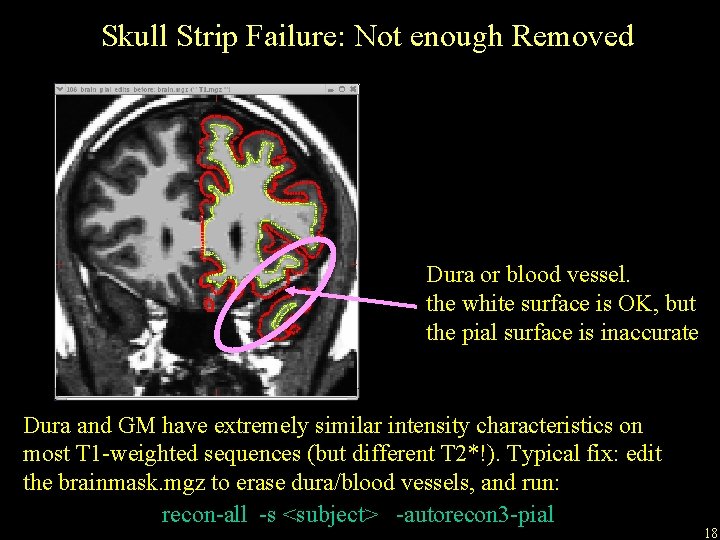 Skull Strip Failure: Not enough Removed Dura or blood vessel. the white surface is