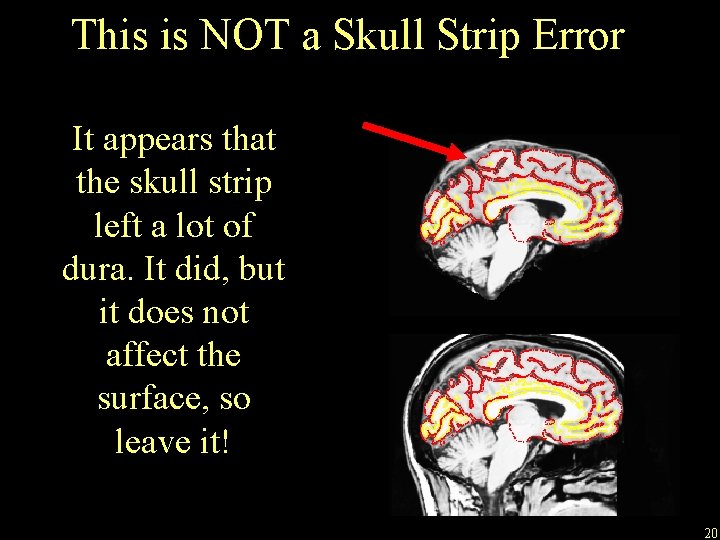This is NOT a Skull Strip Error It appears that the skull strip left