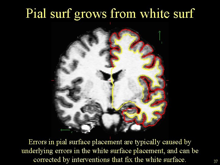 Pial surf grows from white surf Errors in pial surface placement are typically caused
