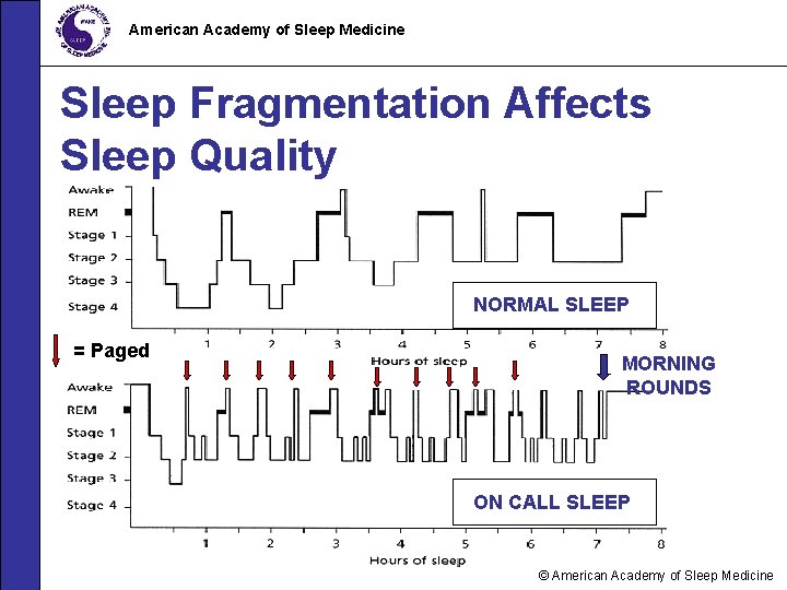 American Academy of Sleep Medicine Sleep Fragmentation Affects Sleep Quality NORMAL SLEEP = Paged