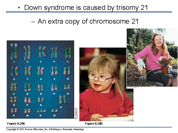  • Down syndrome is caused by trisomy 21 5, 000 – An extra