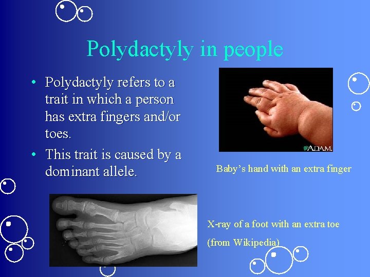 Polydactyly in people • Polydactyly refers to a trait in which a person has
