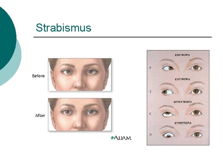 Strabismus 