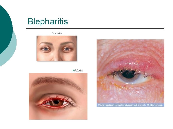 Blepharitis 