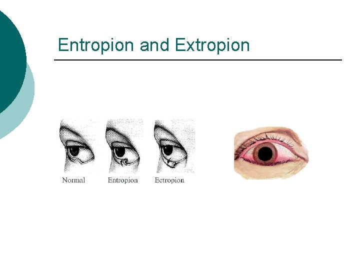 Entropion and Extropion 