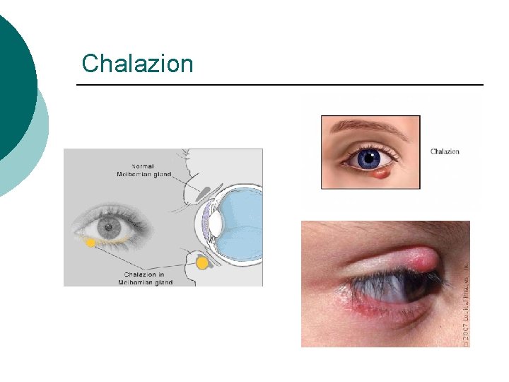 Chalazion 