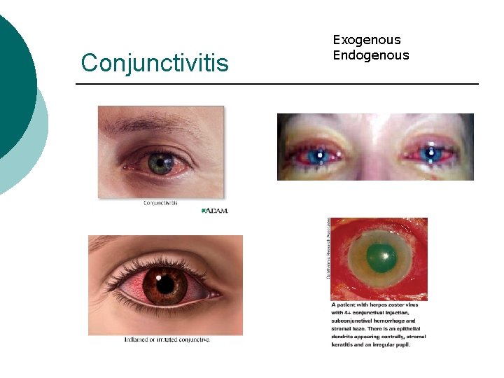Conjunctivitis Exogenous Endogenous 