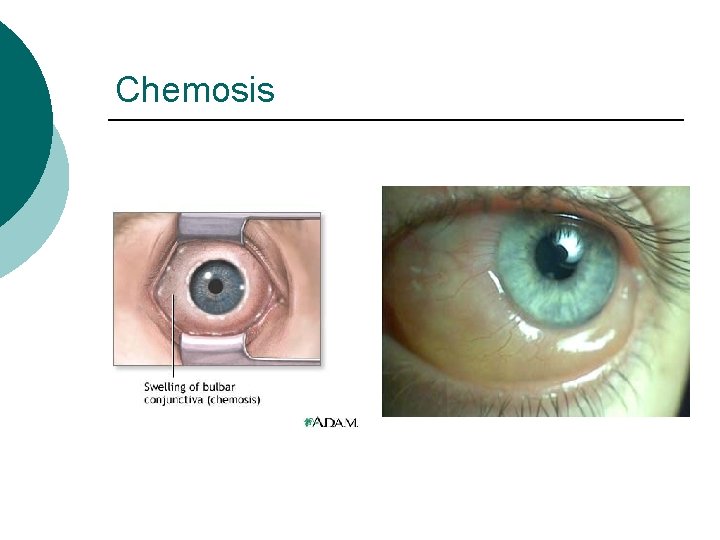 Chemosis 