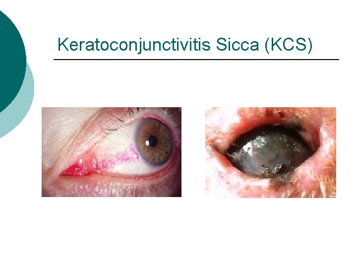 Keratoconjunctivitis Sicca (KCS) 