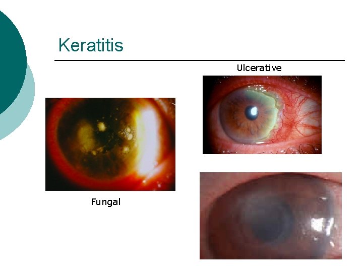 Keratitis Ulcerative Fungal 