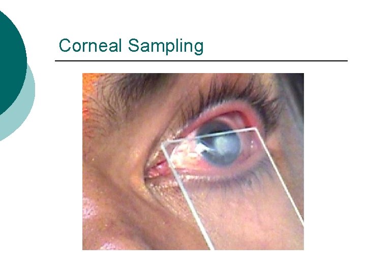 Corneal Sampling 