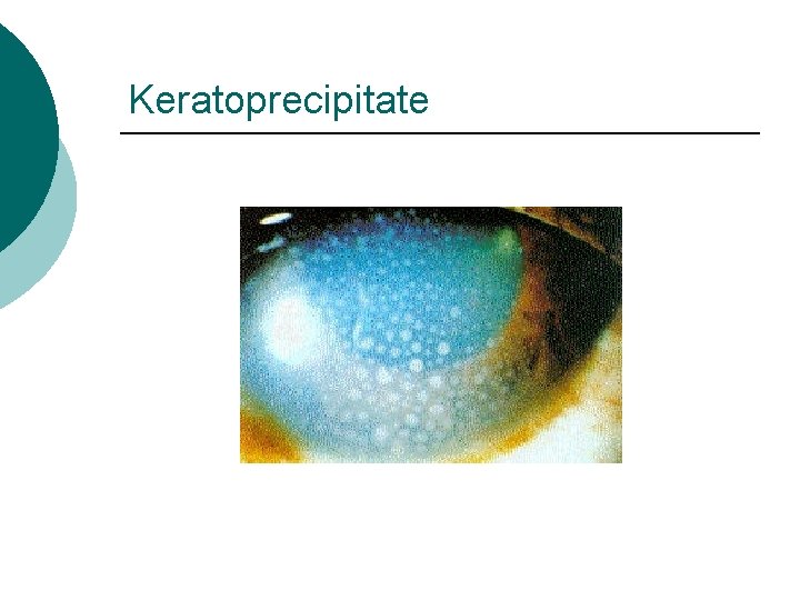 Keratoprecipitate 