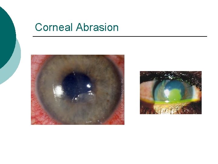 Corneal Abrasion 