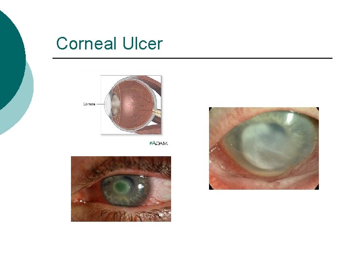 Corneal Ulcer 