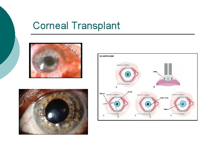 Corneal Transplant 