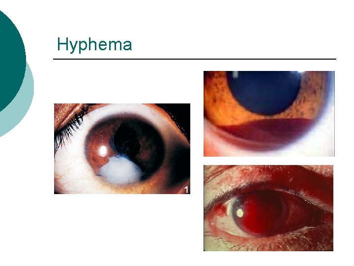 Hyphema 