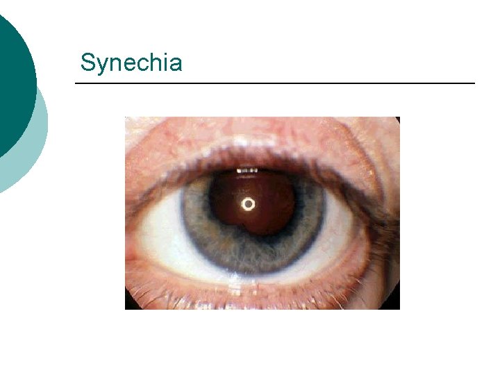 Synechia 