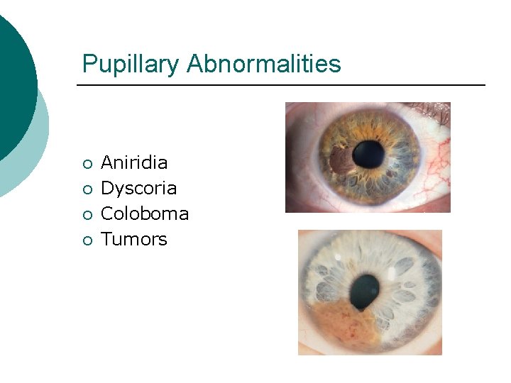 Pupillary Abnormalities ¡ ¡ Aniridia Dyscoria Coloboma Tumors 