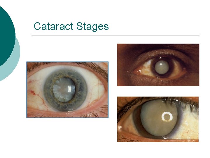 Cataract Stages 