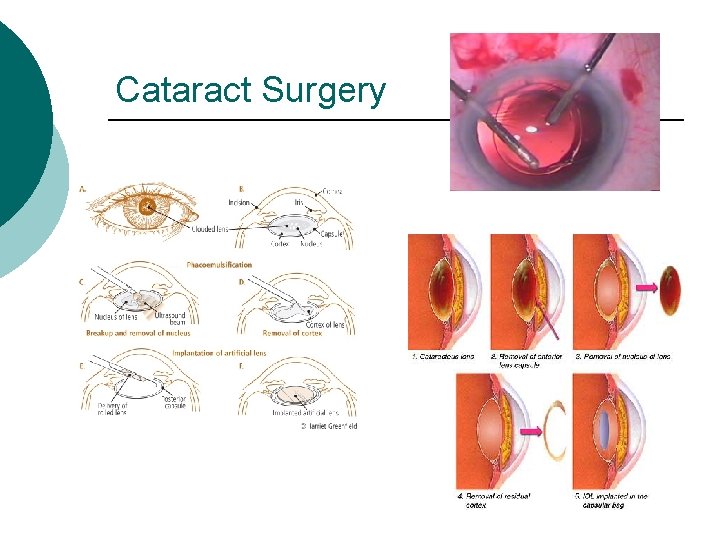 Cataract Surgery 