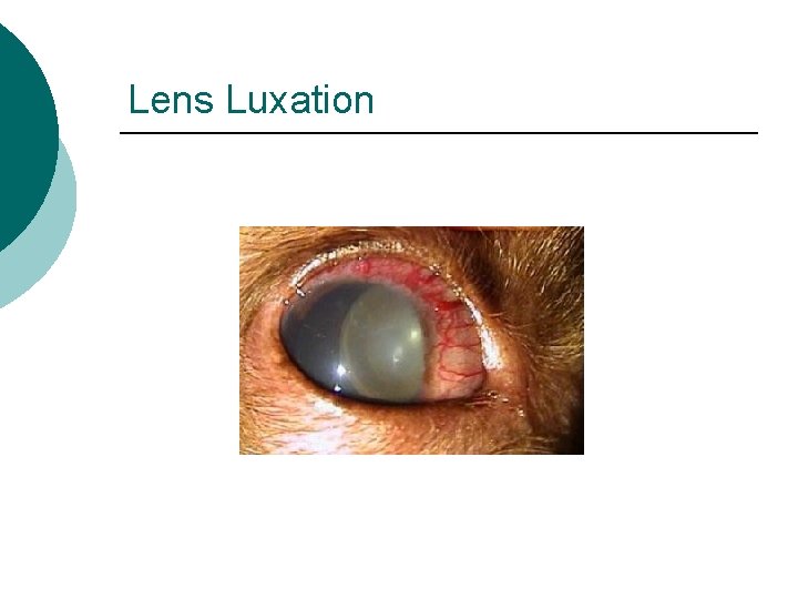 Lens Luxation 