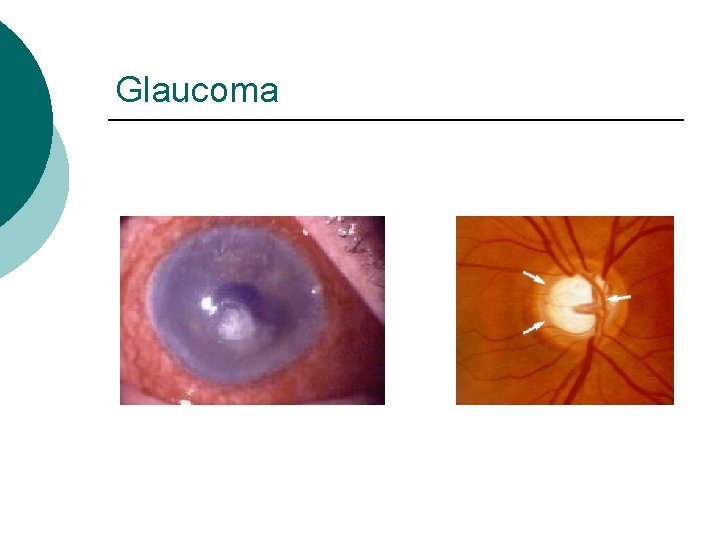 Glaucoma 