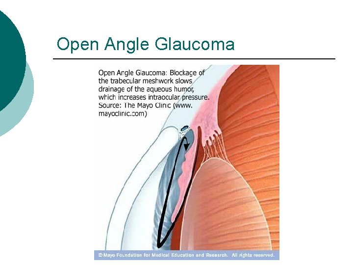 Open Angle Glaucoma 