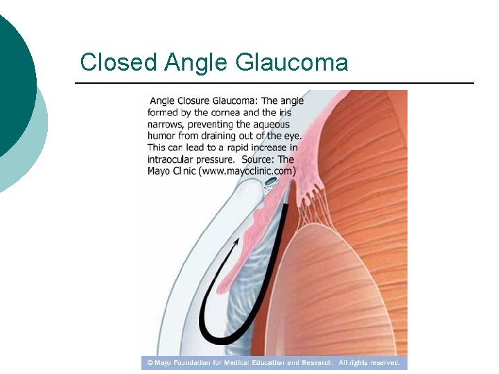 Closed Angle Glaucoma 