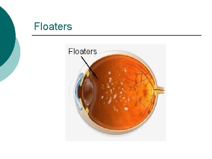 Floaters 