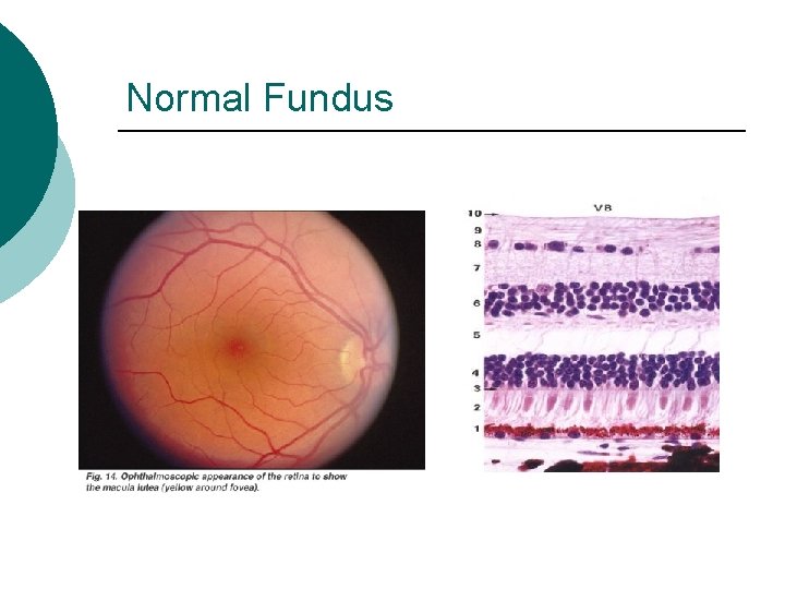 Normal Fundus 