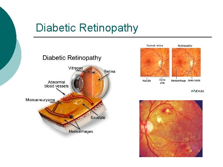 Diabetic Retinopathy 