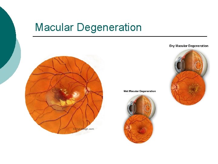 Macular Degeneration 