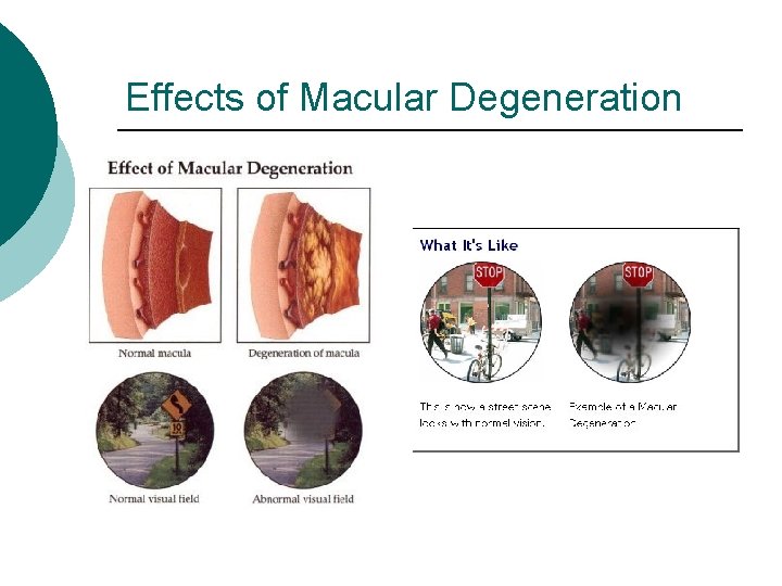 Effects of Macular Degeneration 