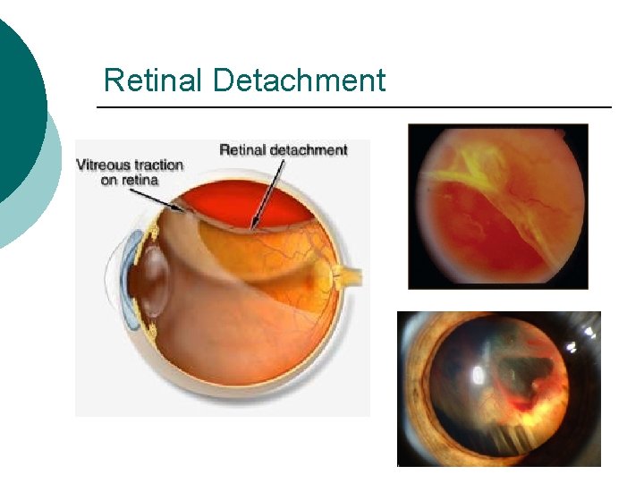 Retinal Detachment 