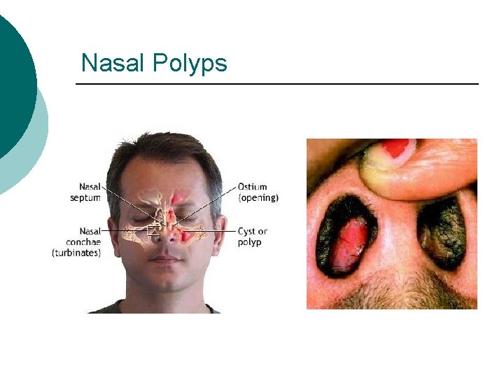 Nasal Polyps 