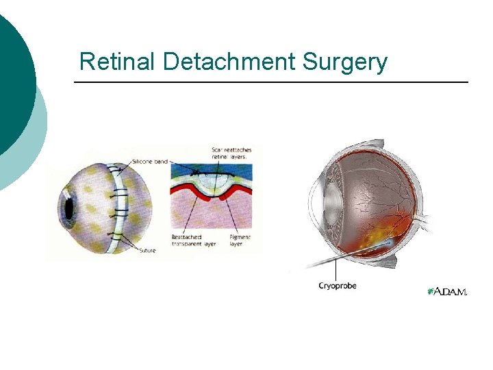 Retinal Detachment Surgery 