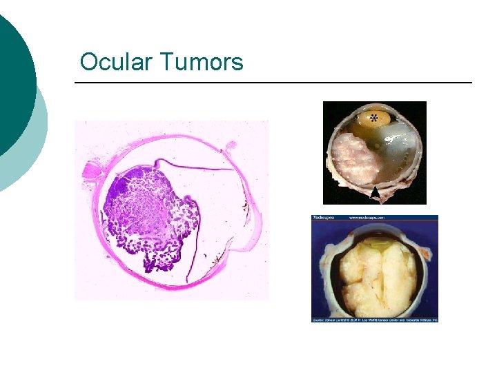 Ocular Tumors 