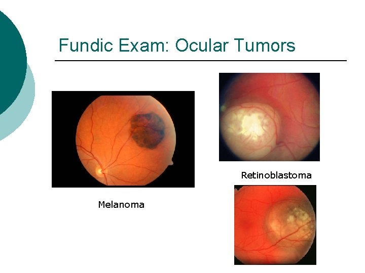 Fundic Exam: Ocular Tumors Retinoblastoma Melanoma 