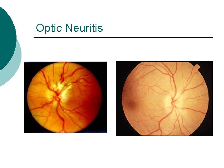 Optic Neuritis 