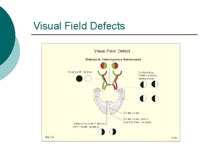 Visual Field Defects 