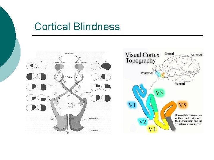 Cortical Blindness 