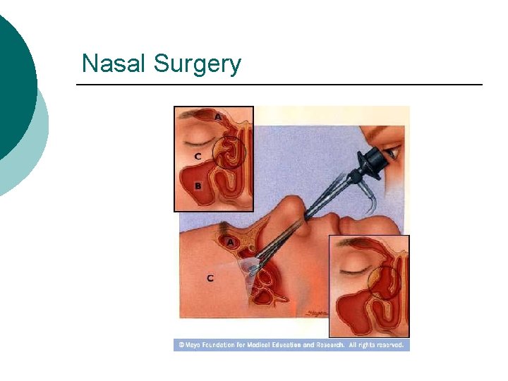 Nasal Surgery 