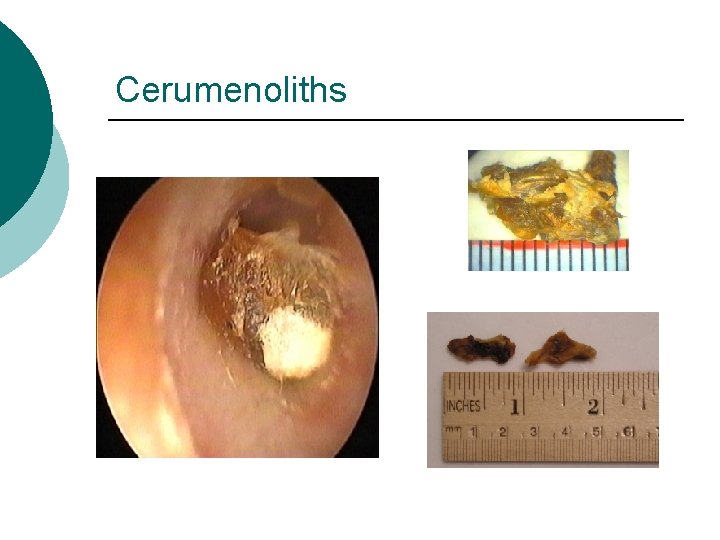 Cerumenoliths 